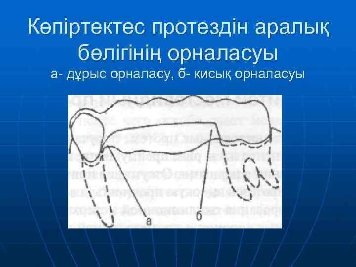 Көпіртектес протездін аралық бөлігінің орналасуы  а- дұрыс орналасу, б- кисық орналасуы 