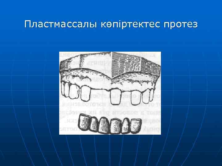Пластмассалы көпіртектес протез 