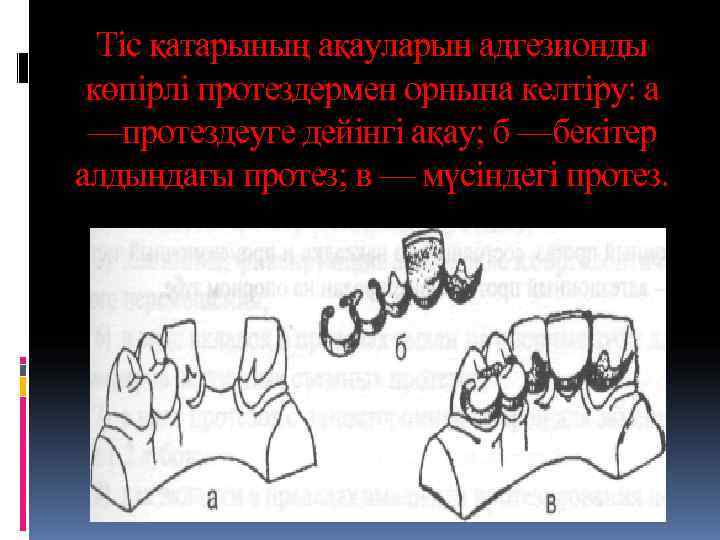  Тіс қатарының ақауларын адгезионды көпірлі протездермен орнына келтіру: а —протездеуге дейінгі ақау; б