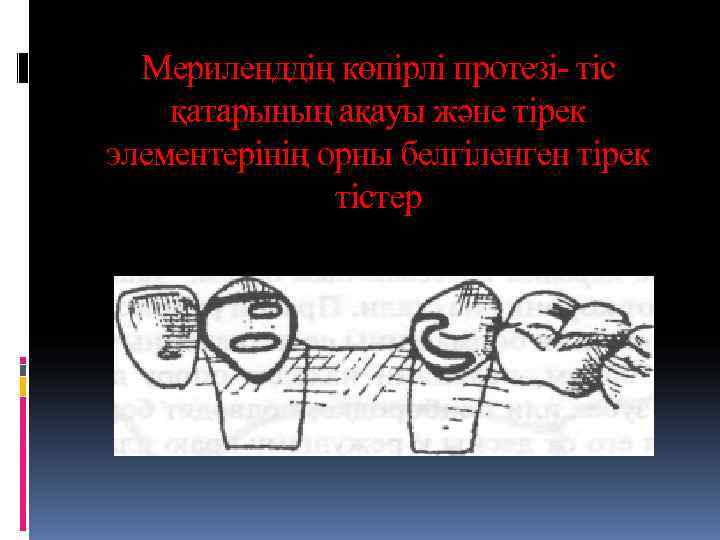  Мериленддің көпірлі протезі- тіс қатарының ақауы және тірек элементерінің орны белгіленген тірек 