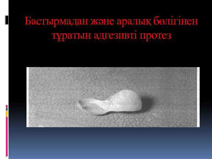 Бастырмадан және аралық бөлігінен тұратын адгезивті протез 