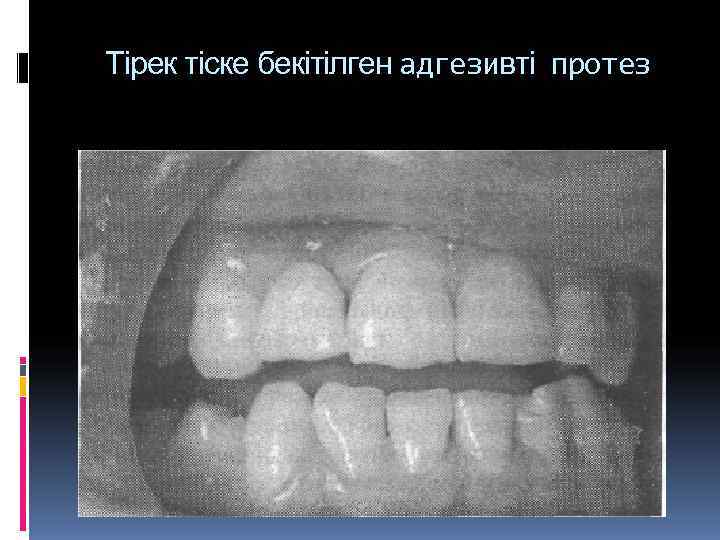   Тірек тіске бекітілген адгезивті протез 