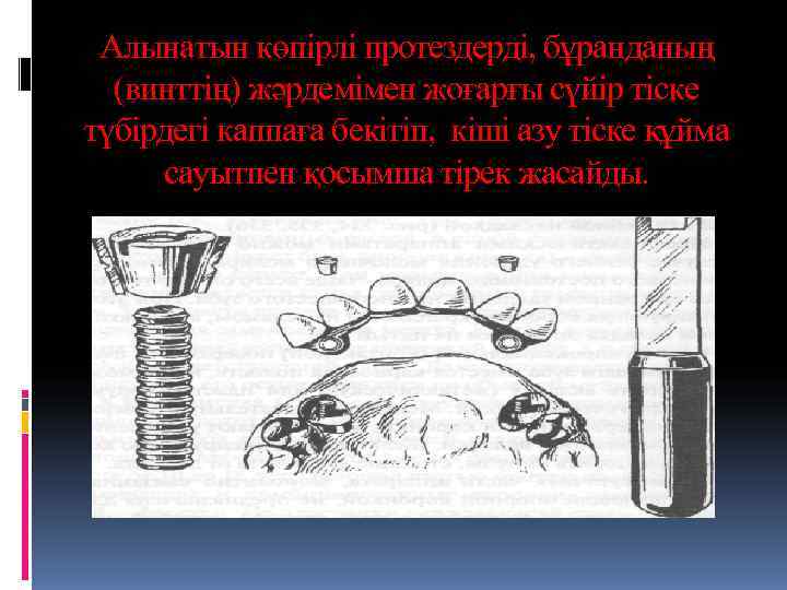  Алынатын көпірлі протездерді, бұранданың  (винттің) жәрдемімен жоғарғы сүйір тіске түбірдегі каппаға бекітіп,