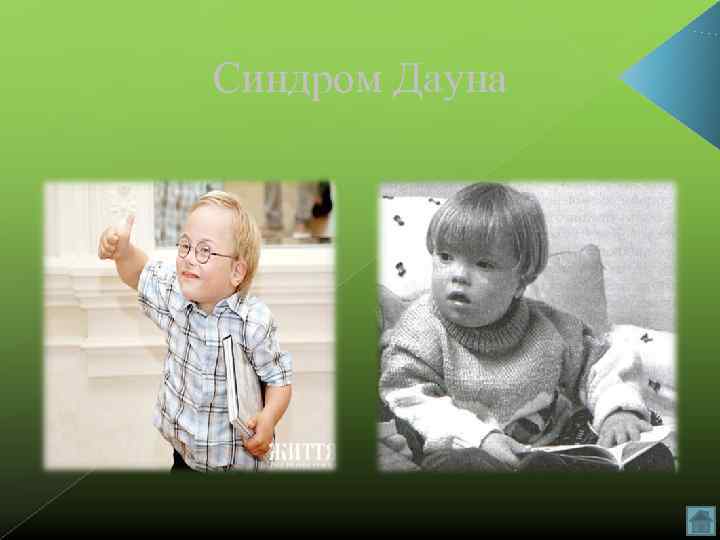 Синдром Дауна 