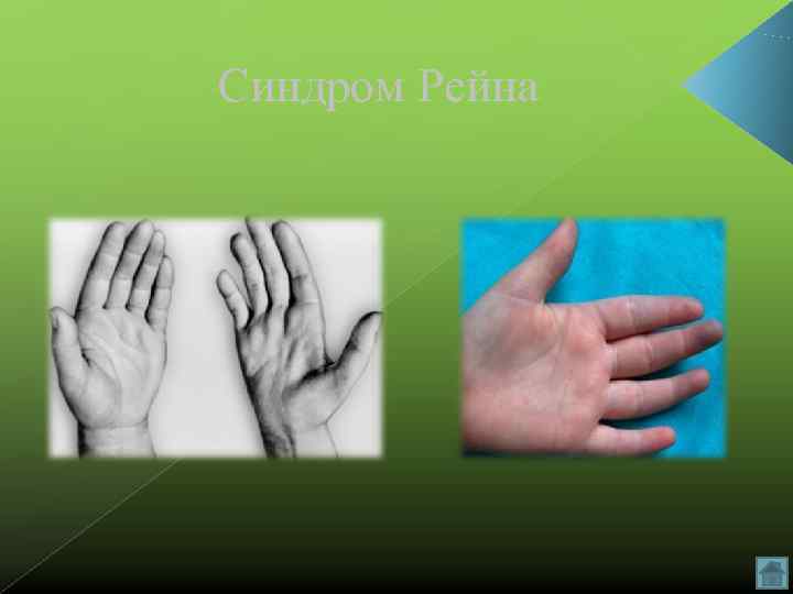 Синдром Рейна 