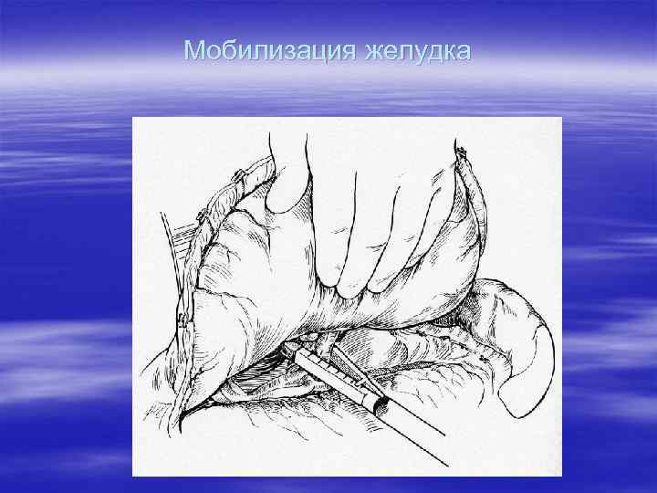Мобилизация желудка 
