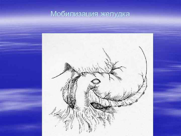 Мобилизация желудка 