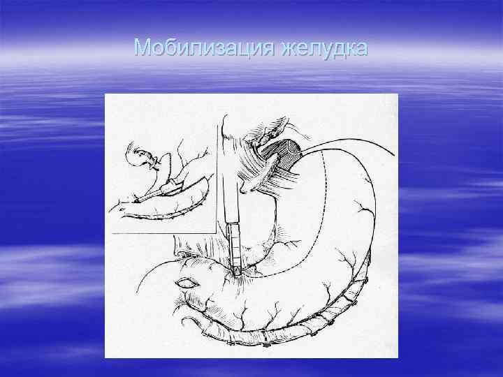 Мобилизация желудка 
