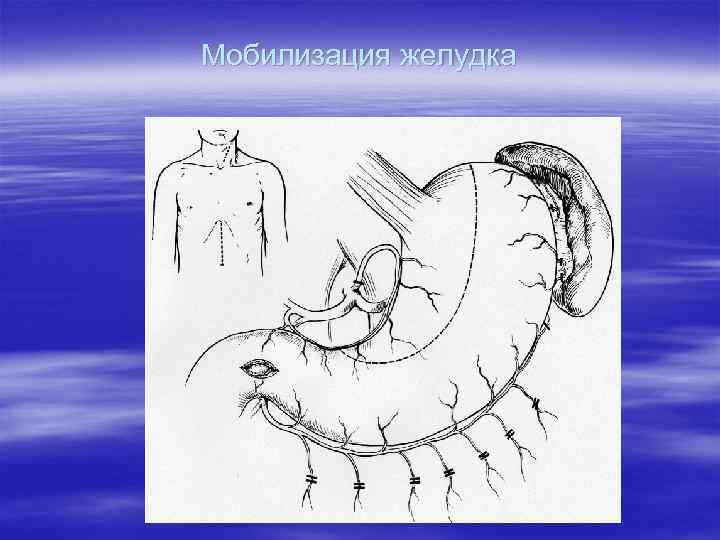 Мобилизация желудка 