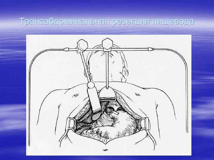 Трансабдоминальная резекция пищевода 