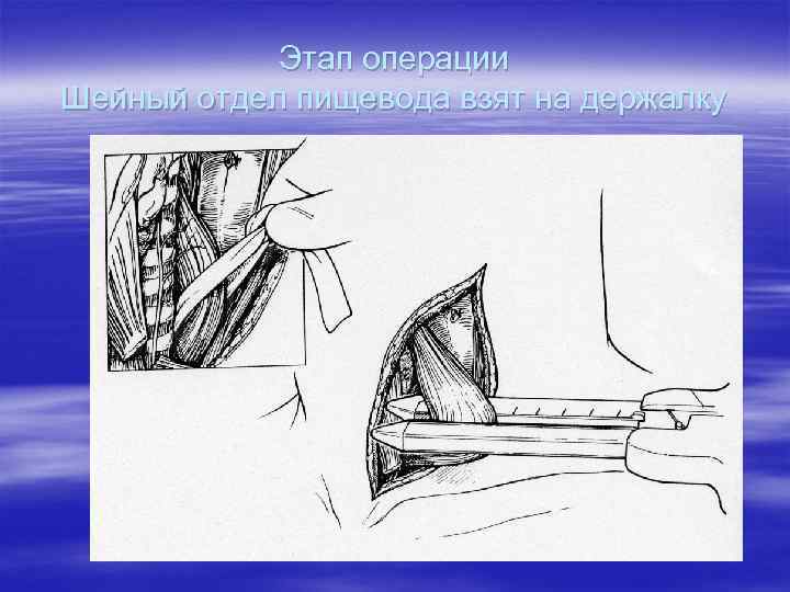   Этап операции Шейный отдел пищевода взят на держалку 