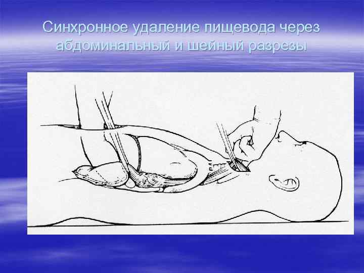 Синхронное удаление пищевода через абдоминальный и шейный разрезы 