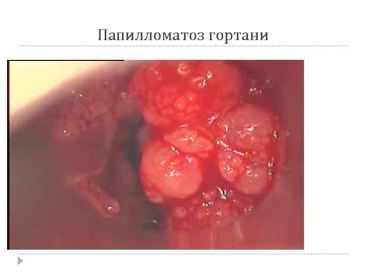 Папилломатоз гортани 