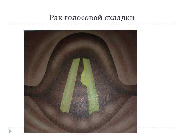 Рак голосовой складки 