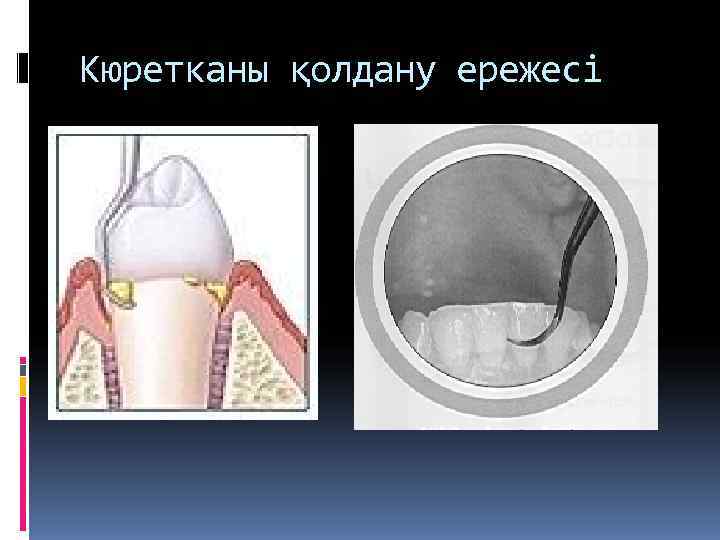 Кюретканы қолдану ережесі 