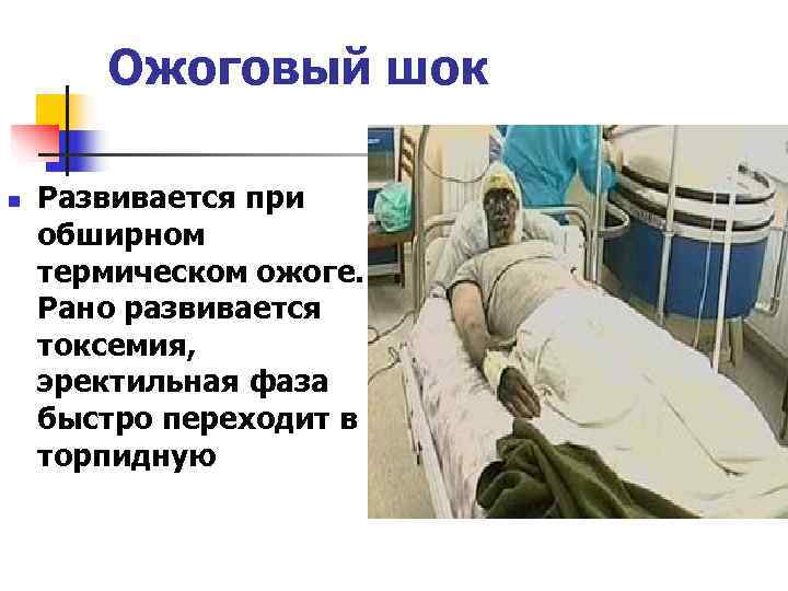  Ожоговый шок n  Развивается при обширном термическом ожоге. Рано развивается токсемия,