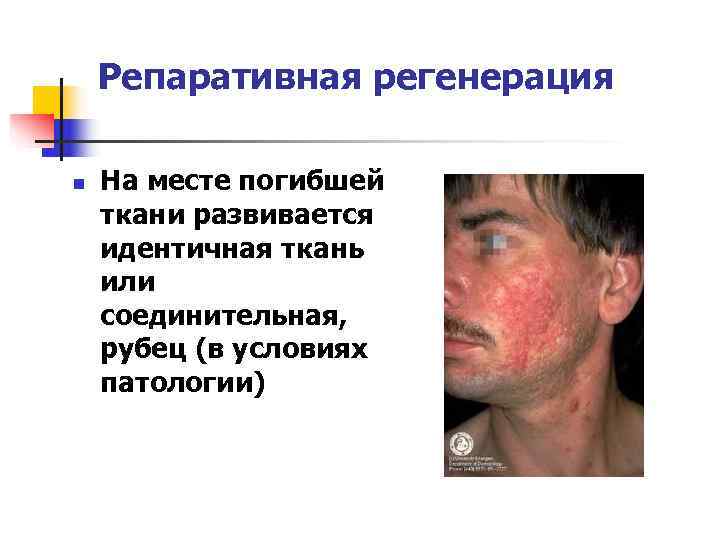   Репаративная регенерация n  На месте погибшей ткани развивается идентичная ткань или
