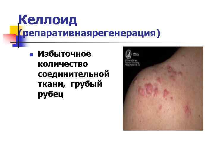 Келлоид (репаративнаярегенерация)  n  Избыточное  количество  соединительной  ткани, грубый 