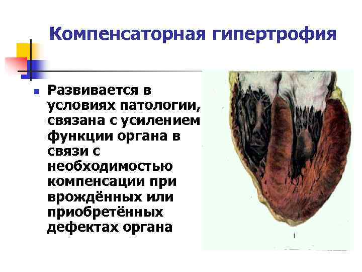   Компенсаторная гипертрофия  n  Развивается в условиях патологии, связана с усилением
