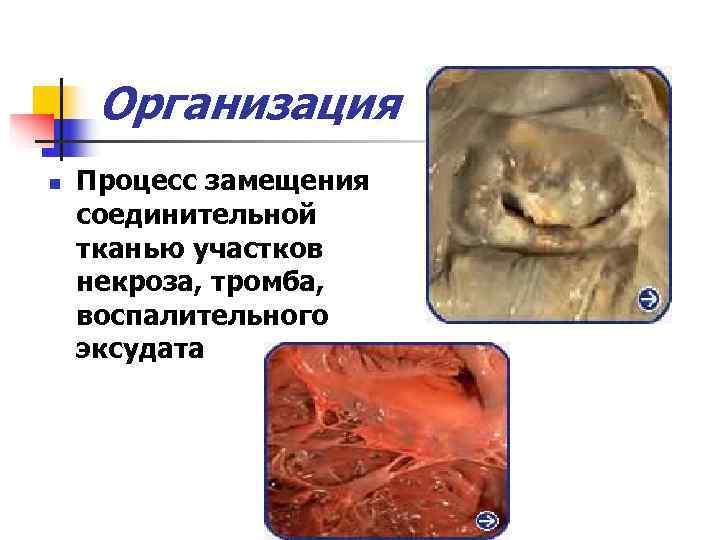  Организация n  Процесс замещения соединительной тканью участков некроза, тромба, воспалительного эксудата 