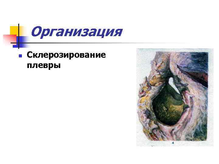   Организация n  Склерозирование плевры 