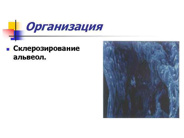  Организация n  Склерозирование альвеол. 