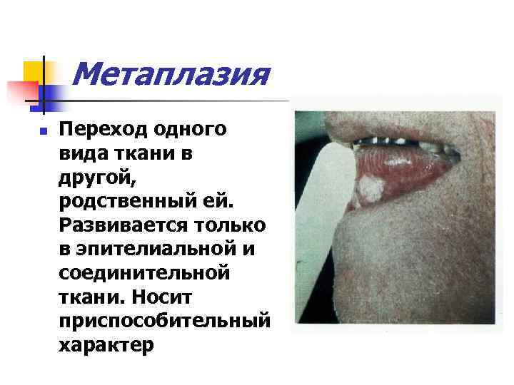   Метаплазия n  Переход одного вида ткани в другой, родственный ей. Развивается