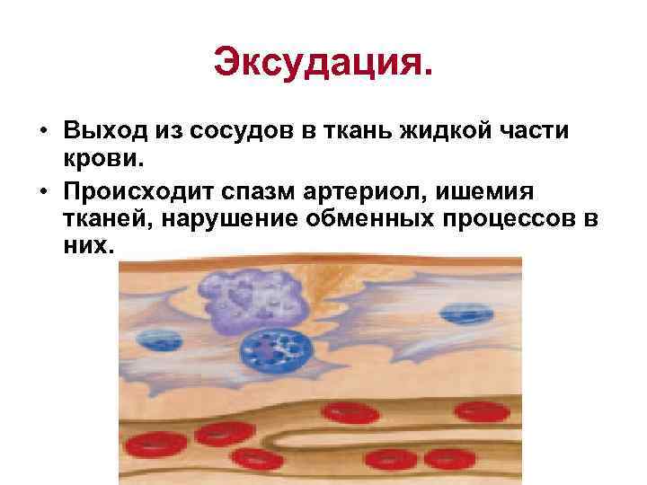 Нарушение тканей. Выход из сосудов в ткань жидкой части крови. Выход жидкости и клеток крови из сосуда. Выход жидкости из сосудов в ткани. Выход жидкости, белков и клеток крови из сосудов в воспаленную ткань.