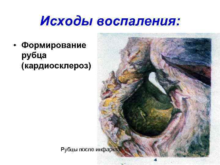  Исходы воспаления:  • Формирование  рубца  (кардиосклероз)    Рубцы