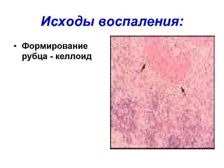  Исходы воспаления:  • Формирование  рубца - келлоид 
