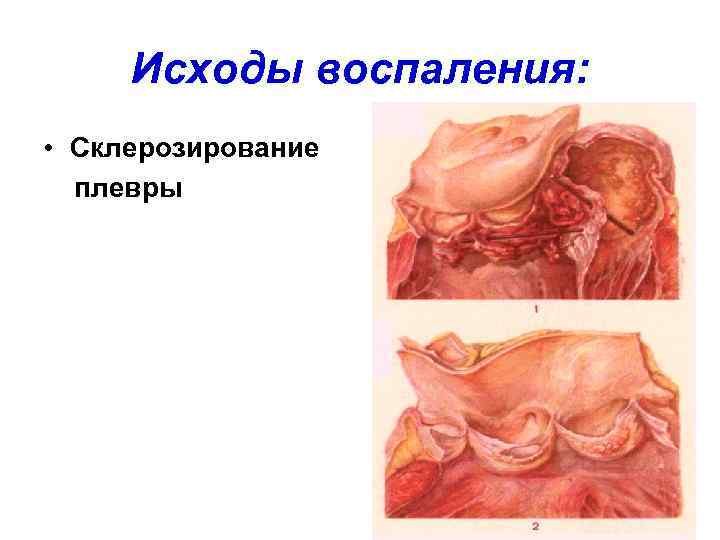  Исходы воспаления:  • Склерозирование  плевры 