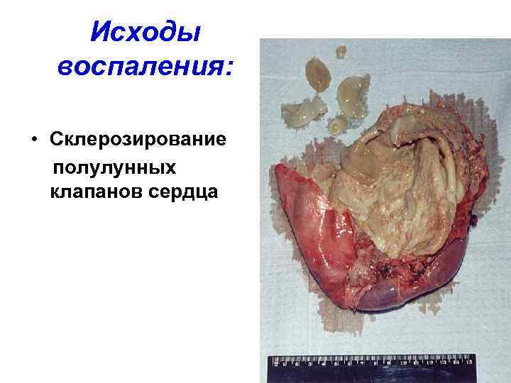   Исходы  воспаления:  • Склерозирование  полулунных  клапанов сердца 