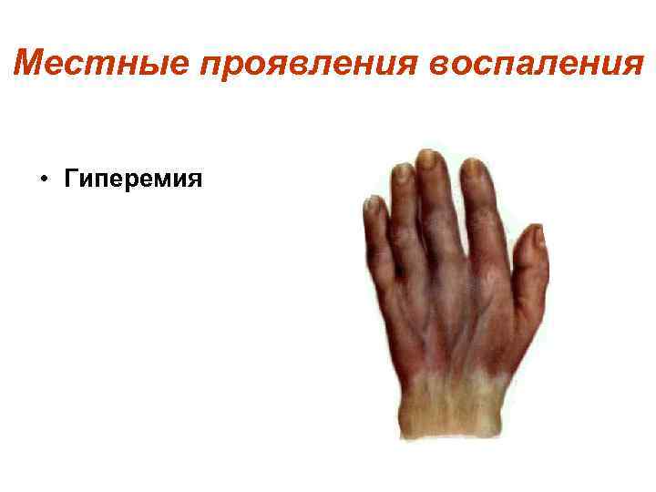 Местные проявления воспаления • Гиперемия 