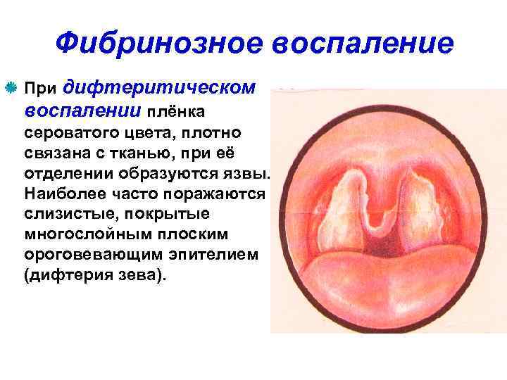   Фибринозное воспаление При дифтеритическом воспалении плёнка сероватого цвета, плотно связана с тканью,