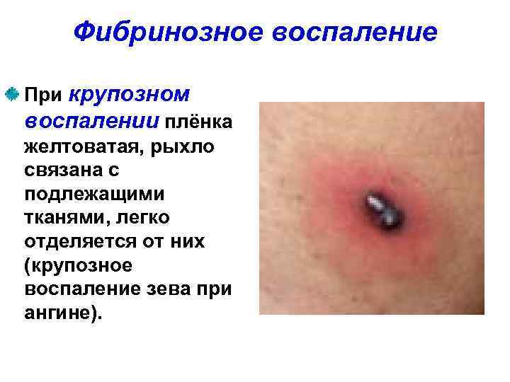   Фибринозное воспаление При крупозном воспалении плёнка желтоватая, рыхло связана с подлежащими тканями,