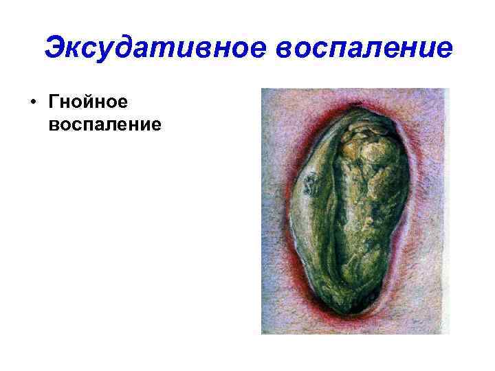  Эксудативное воспаление • Гнойное  воспаление 
