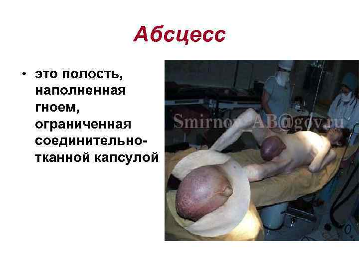    Абсцесс • это полость,  наполненная  гноем,  ограниченная 