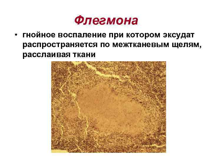   Флегмона • гнойное воспаление при котором эксудат  распространяется по межтканевым щелям,
