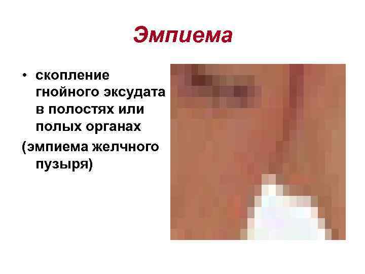    Эмпиема • скопление  гнойного эксудата  в полостях или 