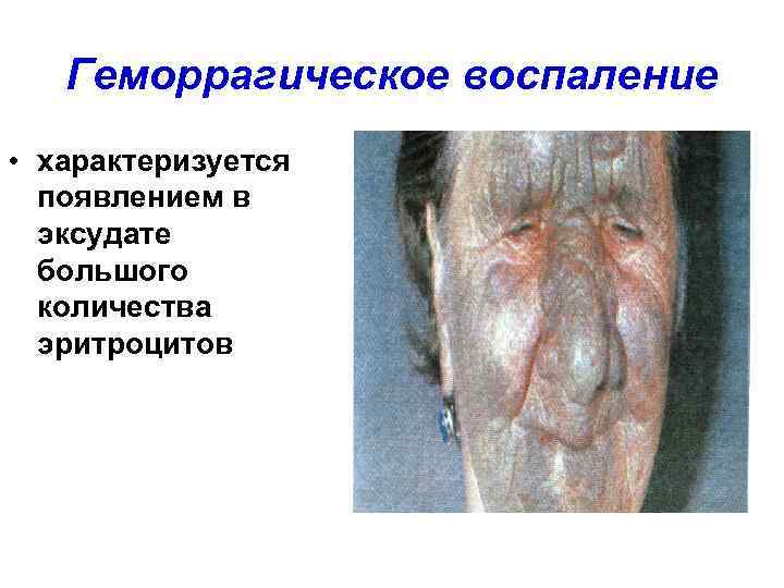   Геморрагическое воспаление • характеризуется  появлением в  эксудате  большого 