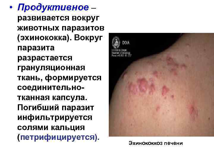  • Продуктивное – развивается вокруг животных паразитов (эхинококка). Вокруг паразита разрастается грануляционная ткань,