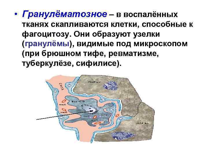  • Гранулёматозное – в воспалённых тканях скапливаются клетки, способные к фагоцитозу. Они образуют