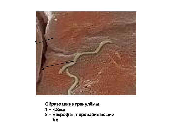 1   2   Образование гранулёмы:   1 – кровь 