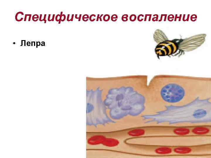 Специфическое воспаление • Лепра 