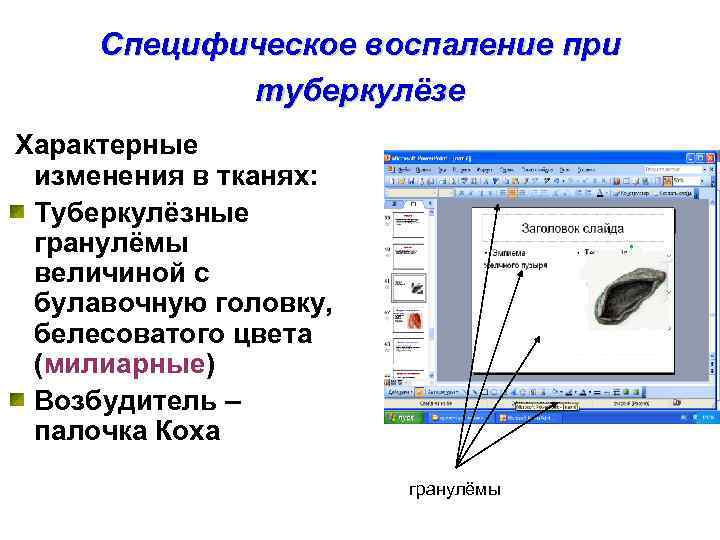  Специфическое воспаление при   туберкулёзе Характерные изменения в тканях:  Туберкулёзные гранулёмы