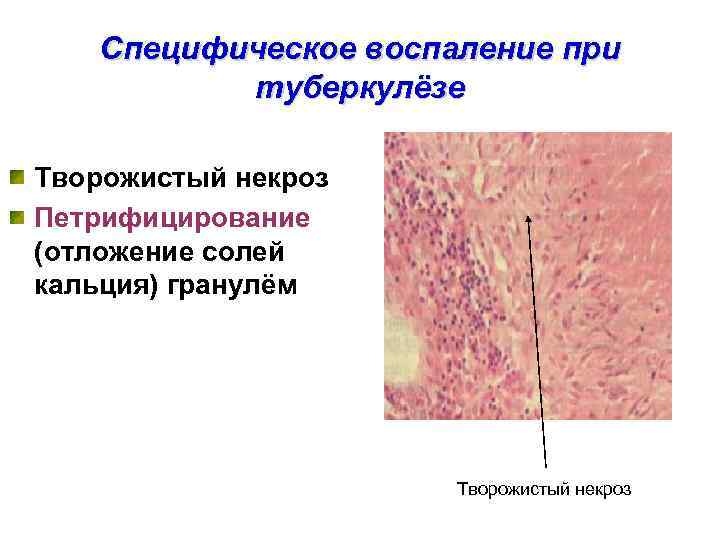   Специфическое воспаление при  туберкулёзе Творожистый некроз Петрифицирование (отложение солей кальция) гранулём