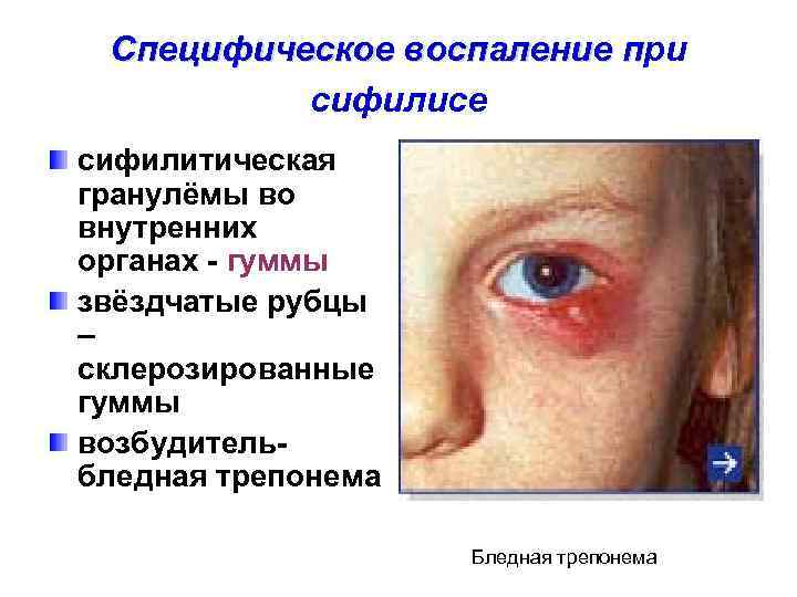  Специфическое воспаление при      п  сифилисе сифилитическая гранулёмы