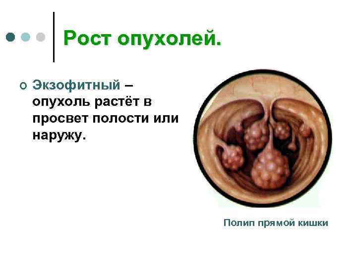   Рост опухолей.  ¢  Экзофитный – опухоль растёт в просвет полости