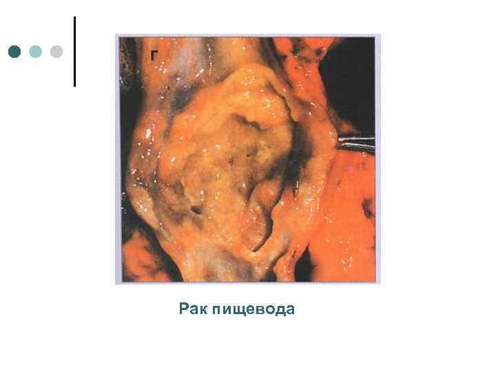 Рак пищевода 