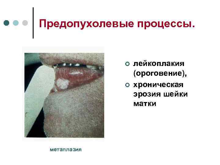 Предопухолевые процессы.   ¢  лейкоплакия    (ороговение),   